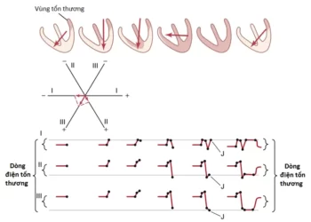 Phân Tích Vector Của Điện Tâm Đồ (Phần 2)