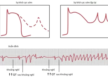Các Loạn Nhịp Tim Và Điện Tâm Đồ Của Chúng (Phần 1)