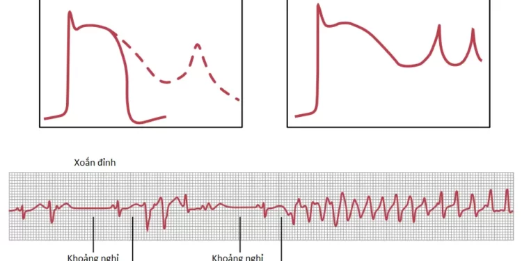 Các Loạn Nhịp Tim Và Điện Tâm Đồ Của Chúng (Phần 1)