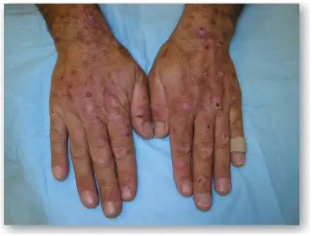 porphyrias-1